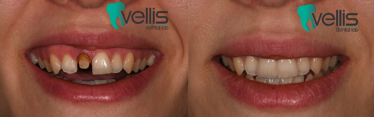 Ασθενής: Γυναίκα Ετών 26 Αποκατάσταση Κεντρικού Τομέα